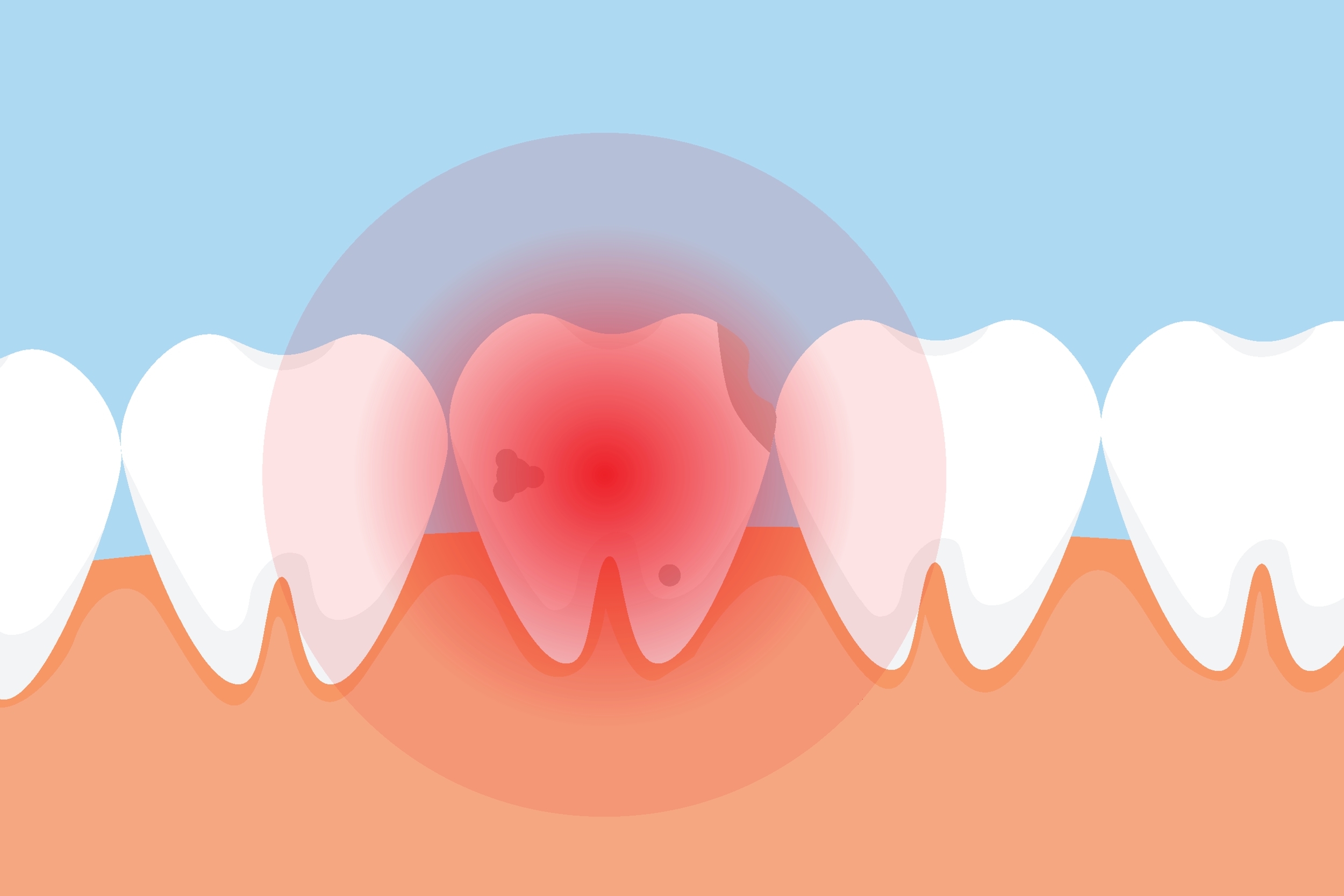 Can an Infected Tooth Affect Your Brain?