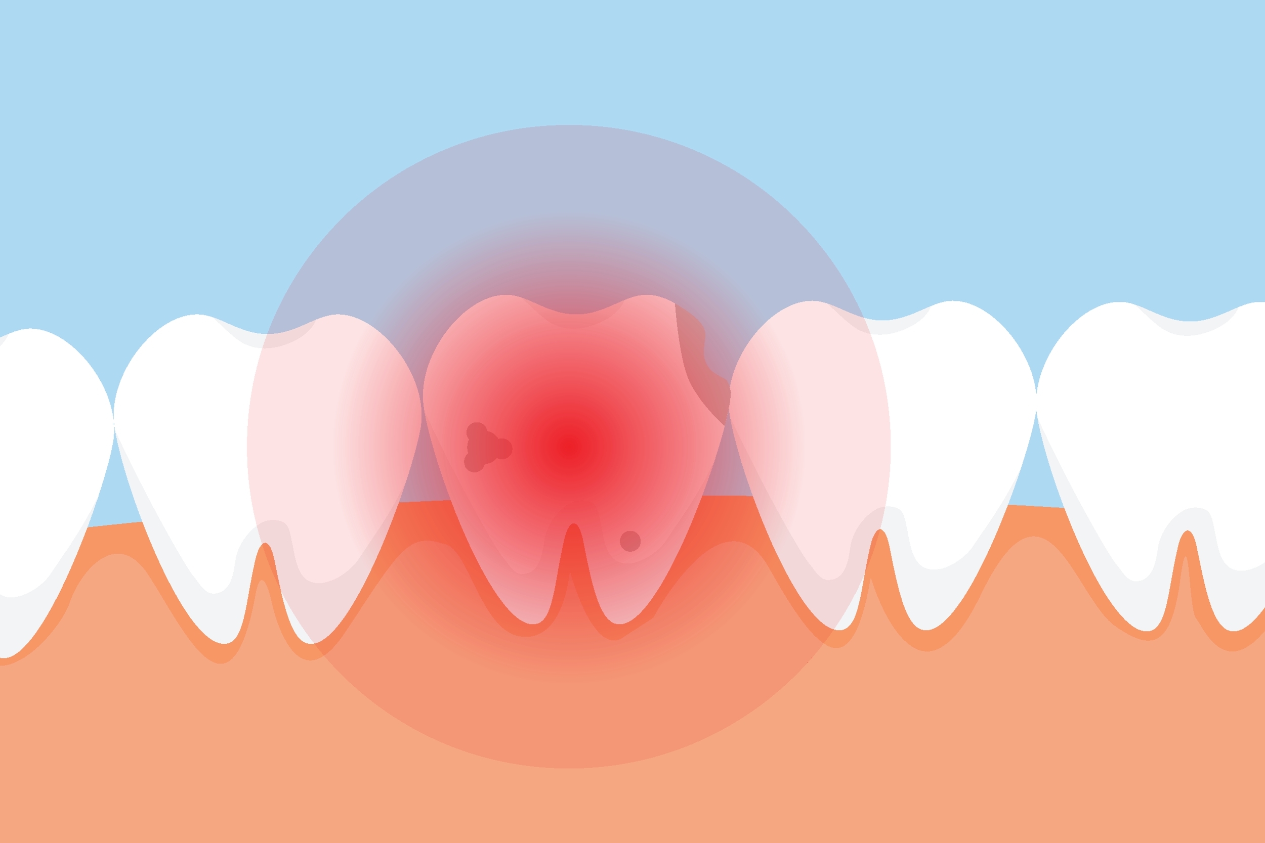 infection-where-wisdom-tooth-used-to-be