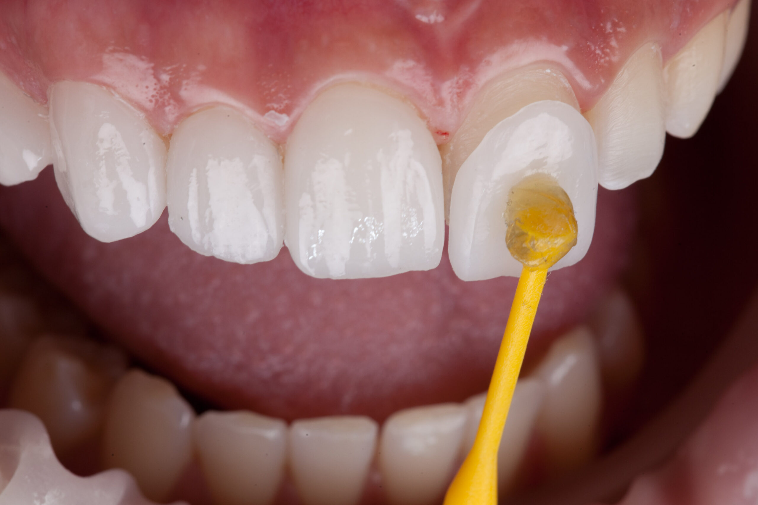 How Can Veneers Improve Your Oral Health?