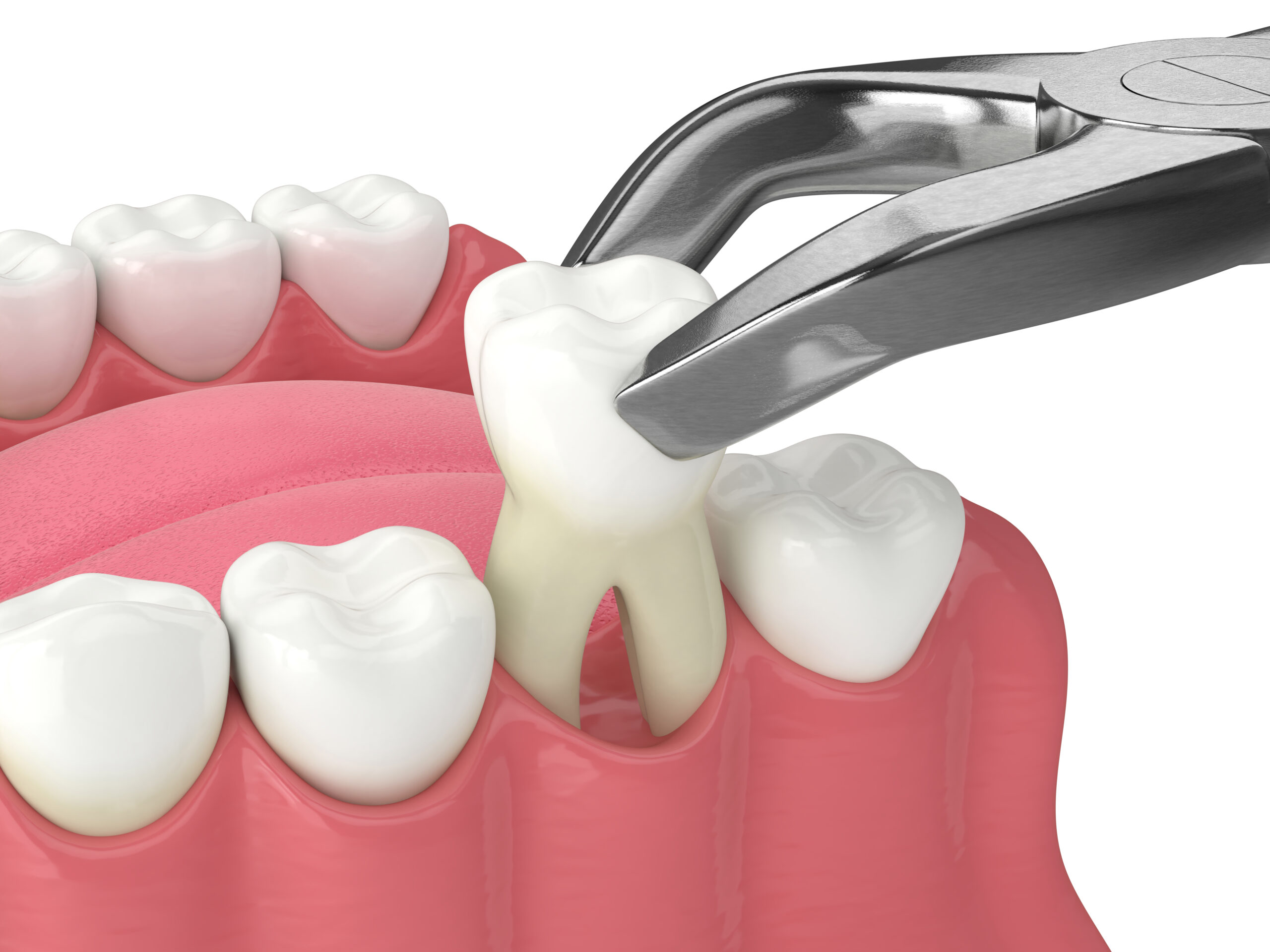 Why Dental Extractions Are Necessary